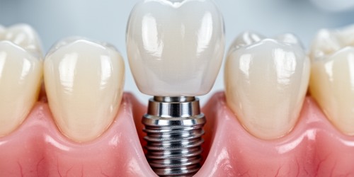 Coroa Sobre Implante: Como Funciona?