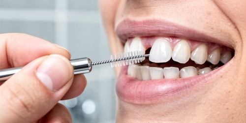 Cuidados Diários para Quem Tem Implante Dentário