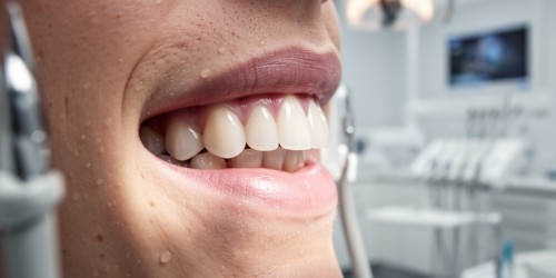 Dente Siso: Quando Precisa Extrair?