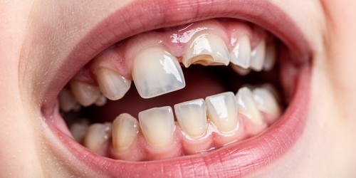 Dente Permanente Nascendo Torto: É Normal?