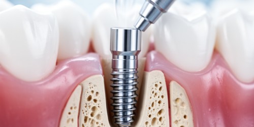 Implante Dentário Sem Enxerto: É Possível?