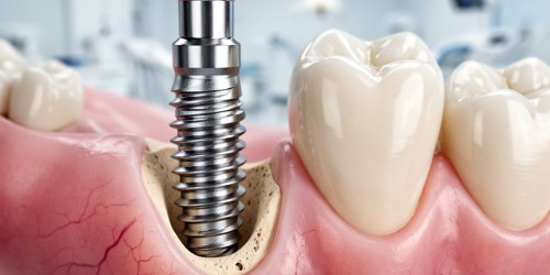 Implante Dentário Unitário: Como Funciona?