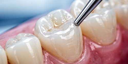 Restauração de Resina: Como Funciona?